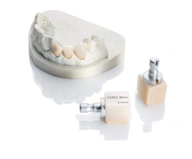 Tooth model showing beautiful crafted crowns via CEREC machine
