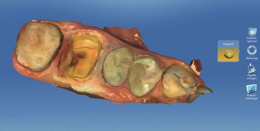 3D model of the scanned area within the mouth showing the tooth that needs a crown as well as the teeth on either side.