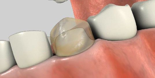 3D image of a tooth that has been shaved down to make room to place a new crown.