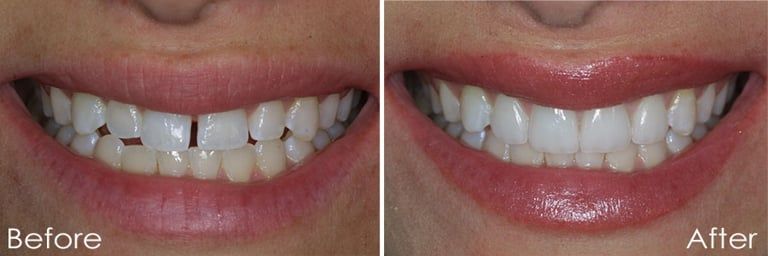 before and after case of veneers. The before image shows gaps between teeth while the after image shows a beautiful and perfect looking teeth